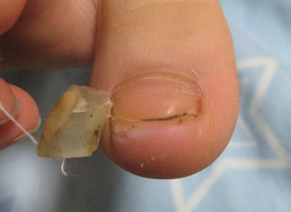 爪 剥がれる 子供 こんな症状に要注意！赤ちゃん&子どもに多い爪トラブル